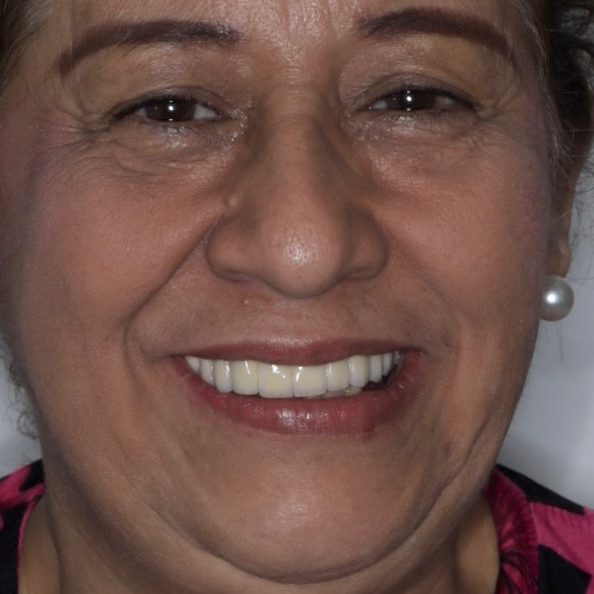 Antes: Sonrisa más clara y armónica