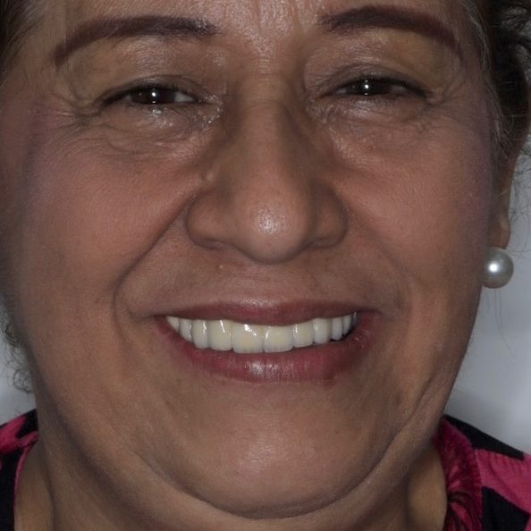 Después: Sonrisa más clara y armónica