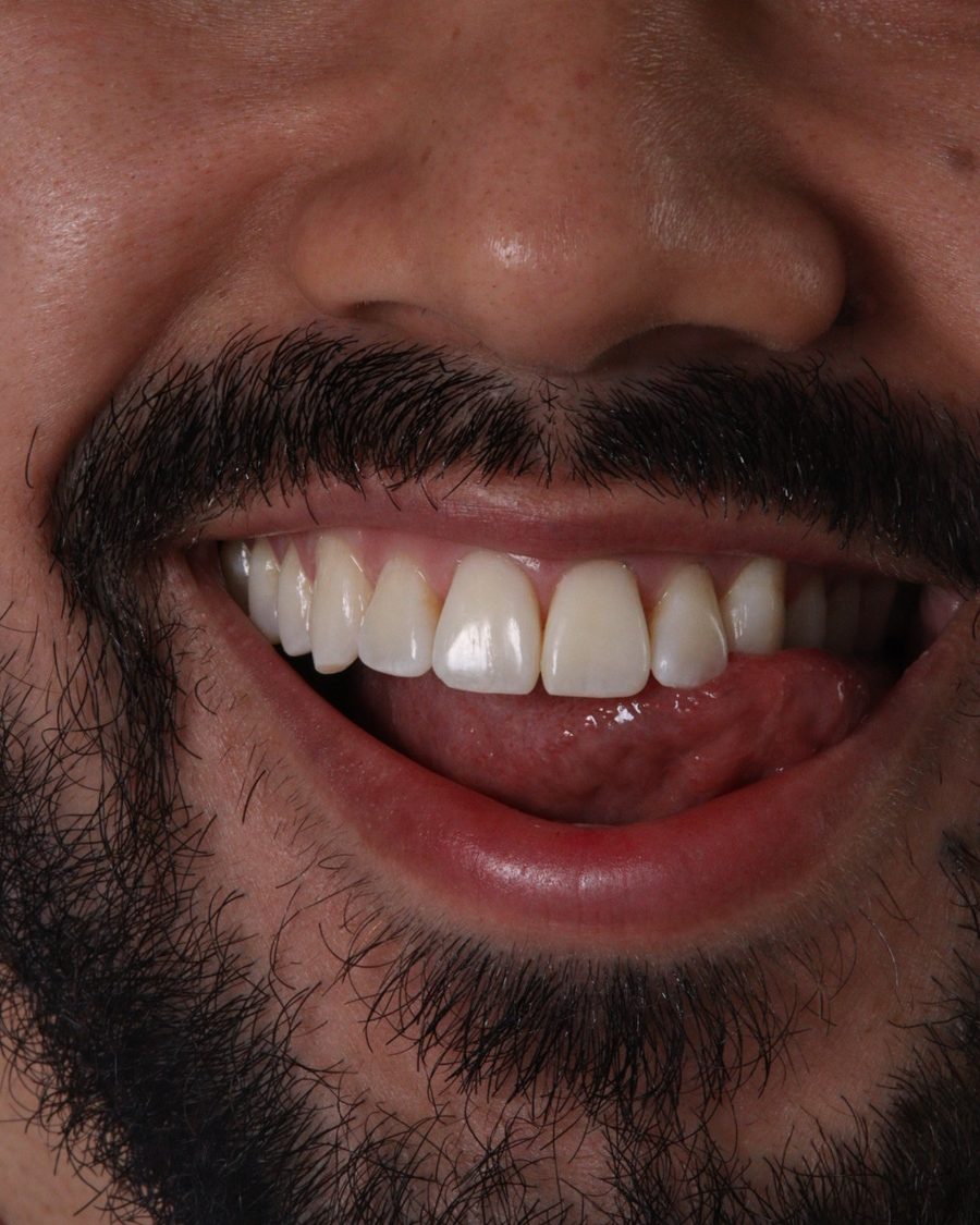 Primer plano de una sonrisa tratada
