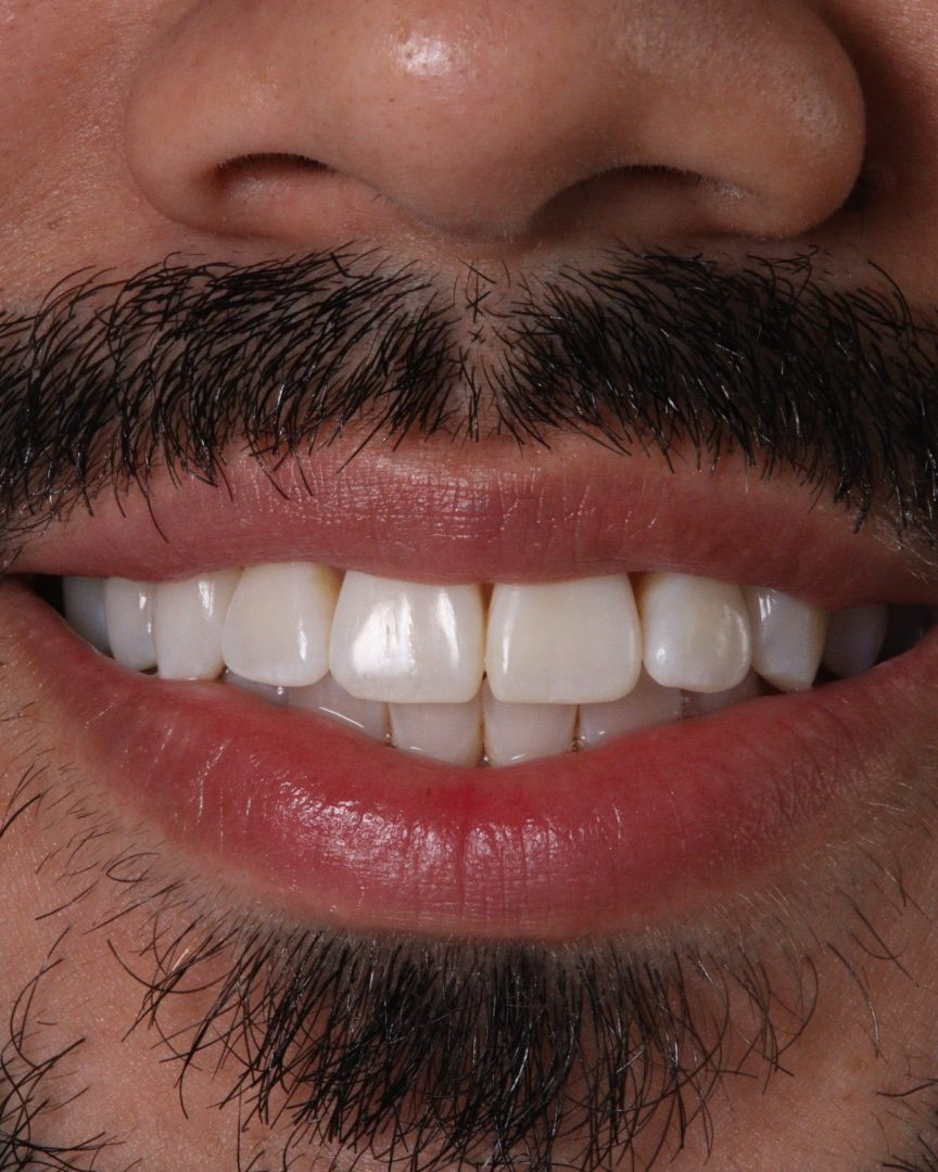 Primer plano de una sonrisa tratada