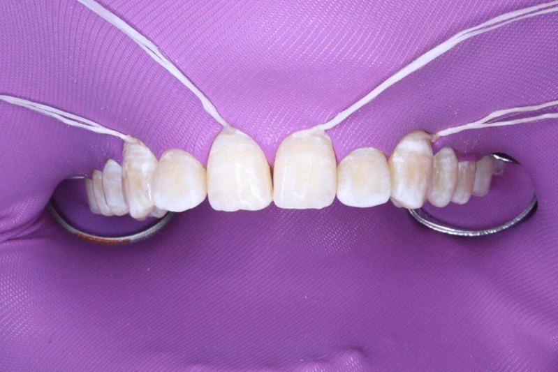 Blanqueamiento dental