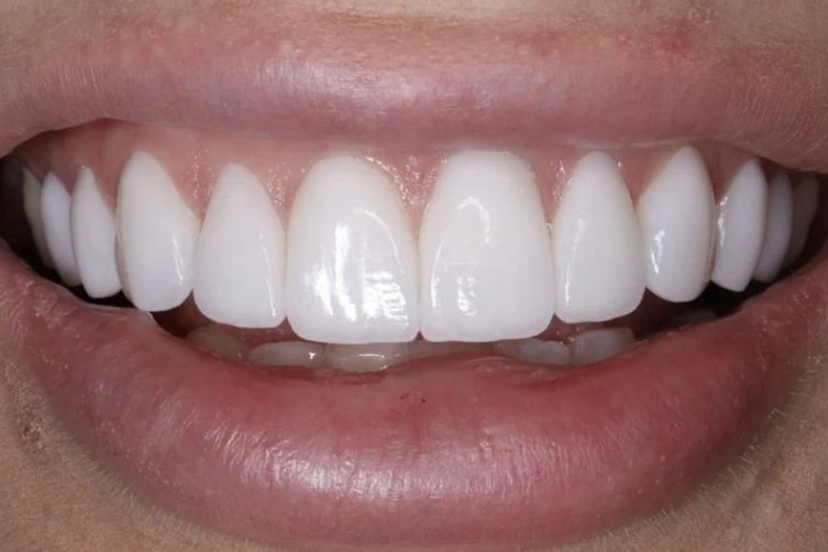 Diseño de sonrisa en cerámica