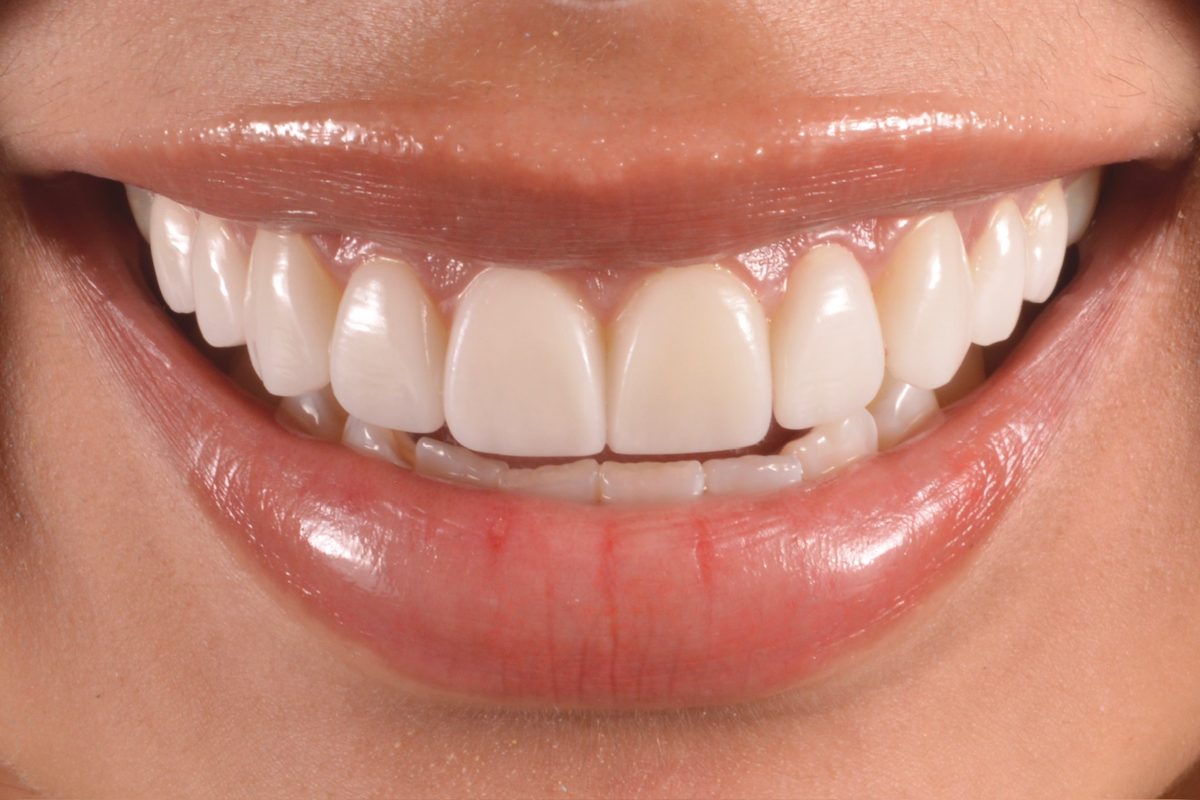 Diseño de sonrisa en resina