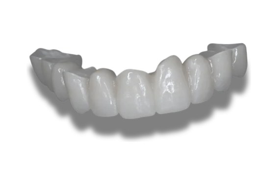Prótesis fija sobre dientes