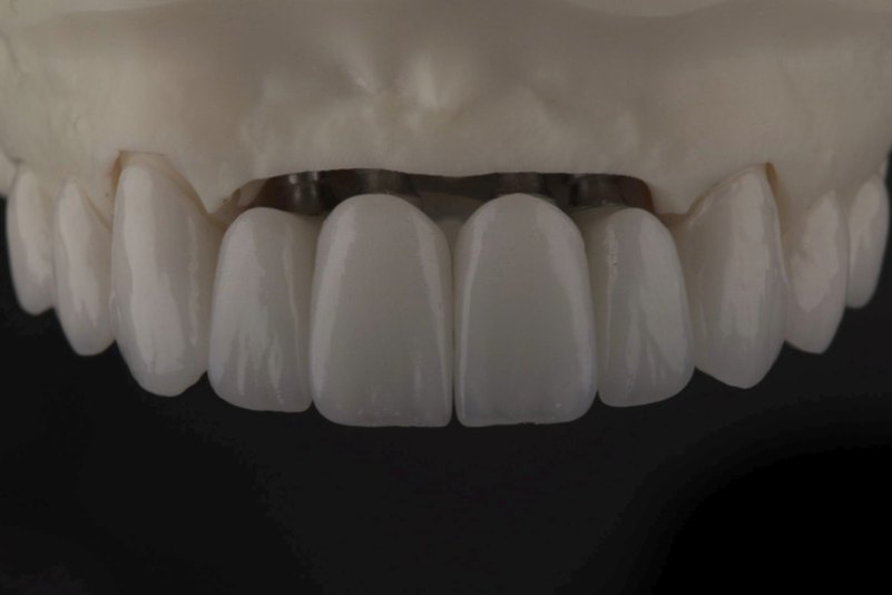 Prótesis fija sobre implantes