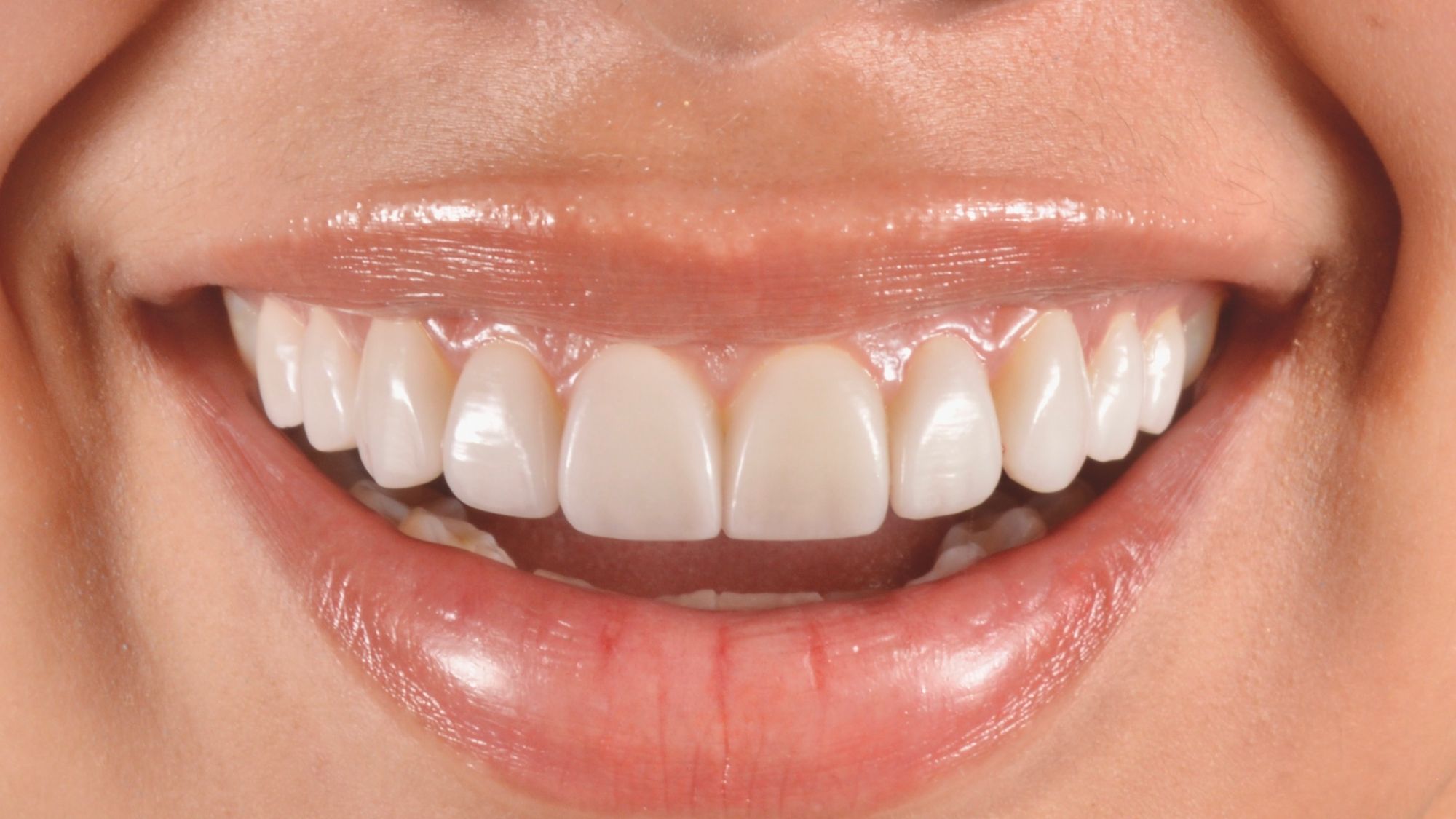 Primer plano de una sonrisa con carillas