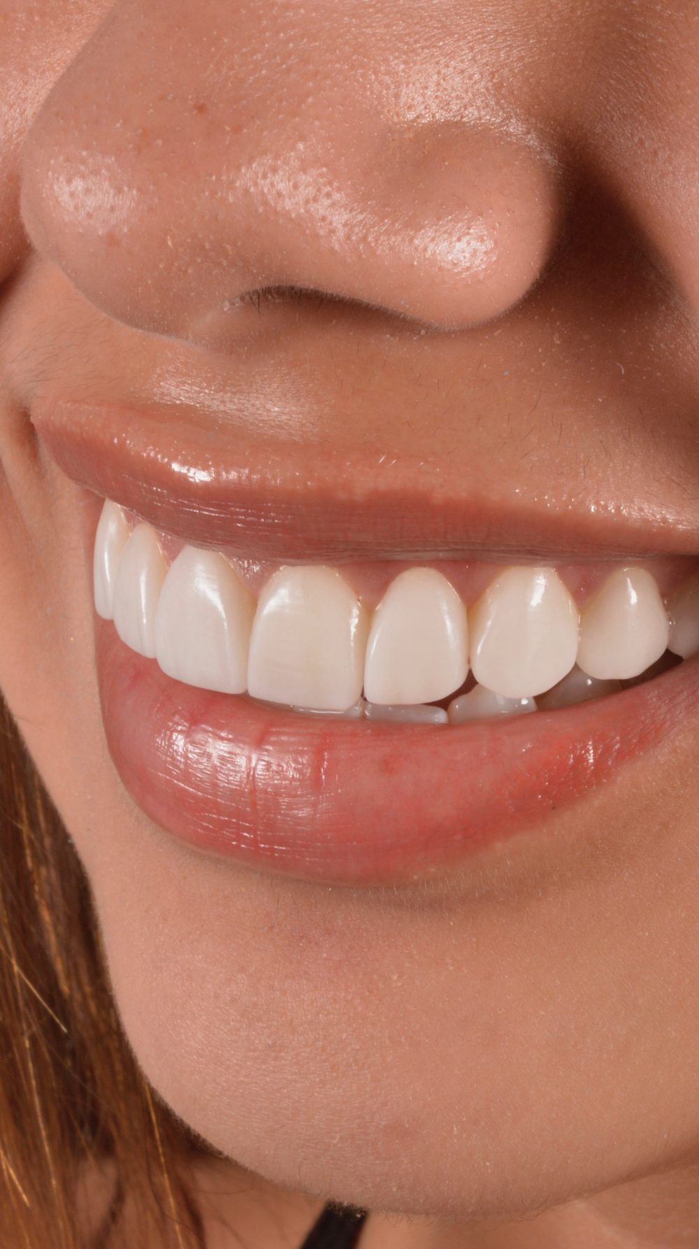 Perfil de una sonrisa con carillas
